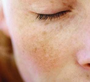 CÓMO QUITAR LAS MANCHAS DE LA CARA